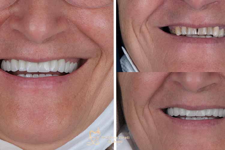 قبل و بعد لمینت سرامیکی