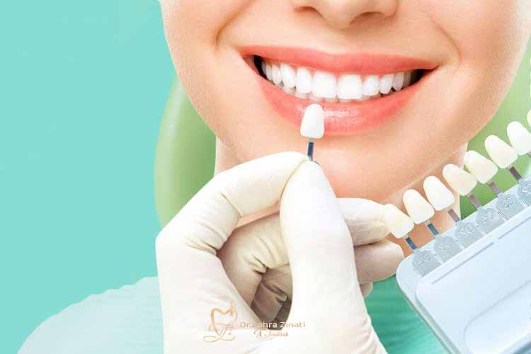 لمینت سرامیکی