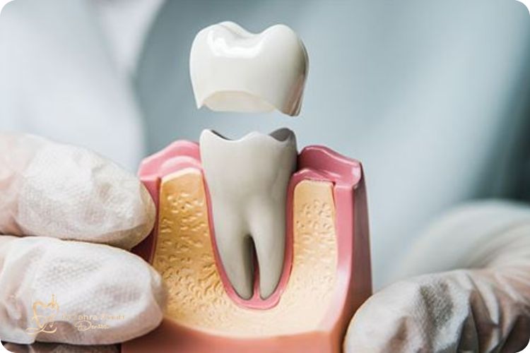 قیمت لنولع روکش دندان 