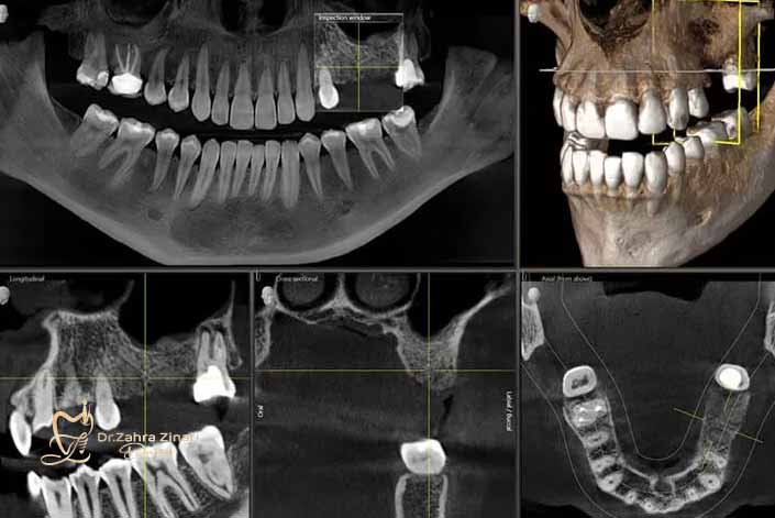 عکس دندان cbct