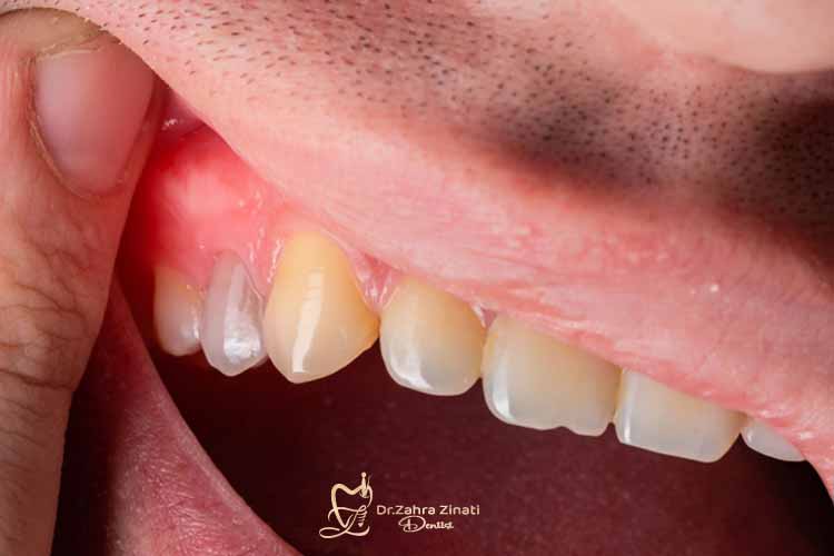 تورم، از نشانه‌های آبسه دندان