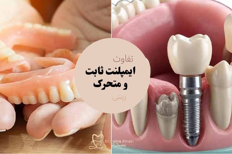 فرق ایمپلنت ثابت و متحرک