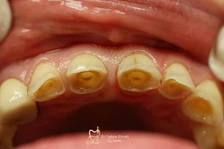 پیشگیری از خرابی مینای دندان 