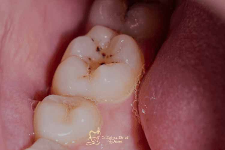 رفع تیرگی دندان