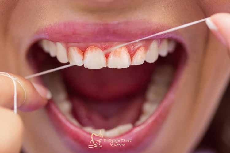 بررسی تخصصی عوامل اصلی بروز خونریزی لثه در حین نخ دندان کشیدن