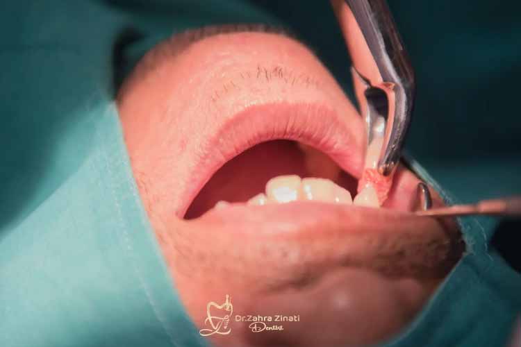 بررسی تخصصی عوارض کشیدن دندان 