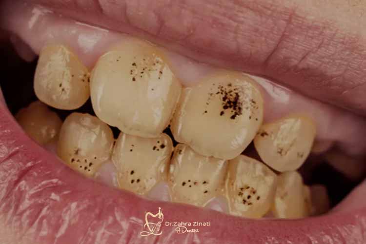 رفع تیرگی دندان