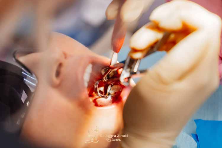 اقدامات پیشگیرانه موثر برای جلوگیری از عوارض کشیدن دندان 