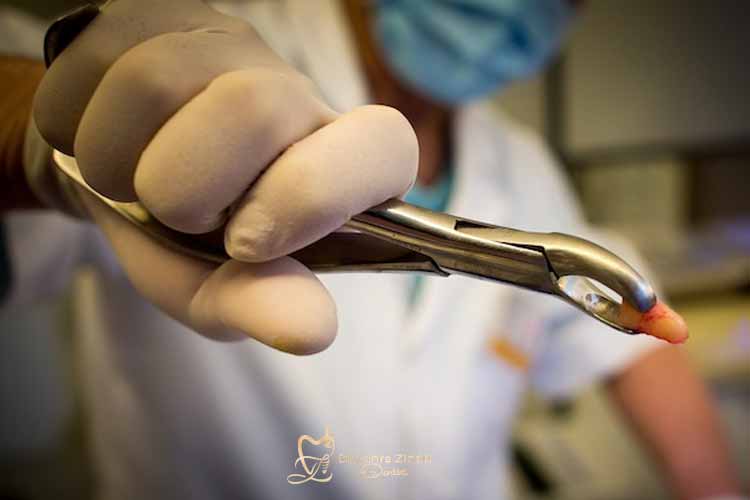 دلایل اصلی و شرایط اجتناب‌ناپذیر بودن عوارض کشیدن دندان