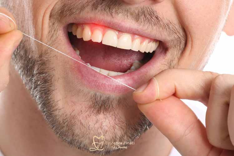 علت خونریزی لثه هنگام کشیدن نخ دندان 