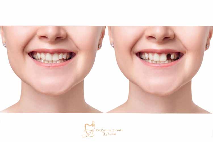 پر کردن جای خالی دندان؛ فواید، مراحل و تأثیر بر سلامت دهان