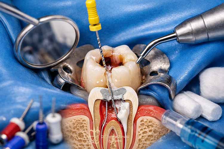 درمان فوری ریشه دندان
