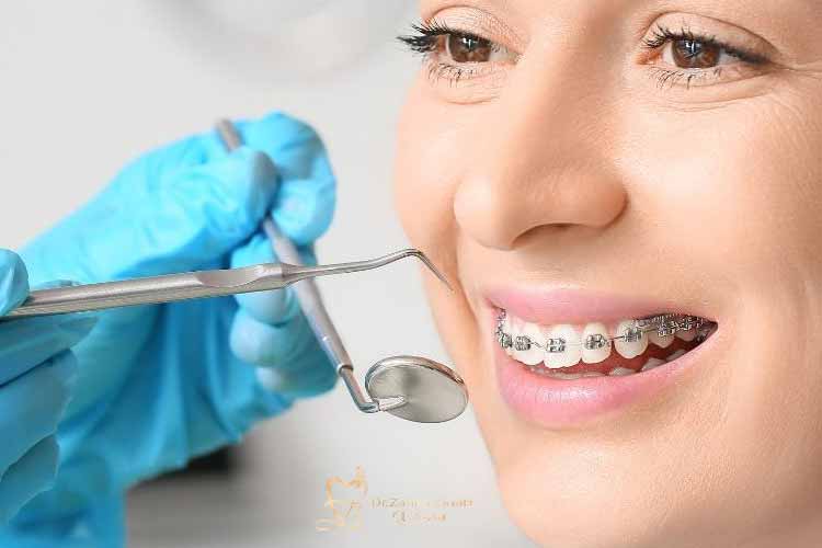 قیمت ارتودنسی دیمون