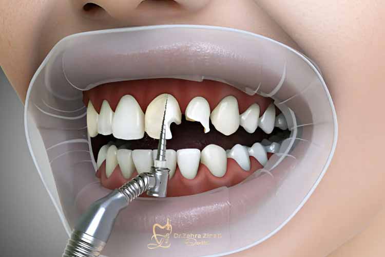 ترمیم لبخند با باندینگ کامپوزیتی