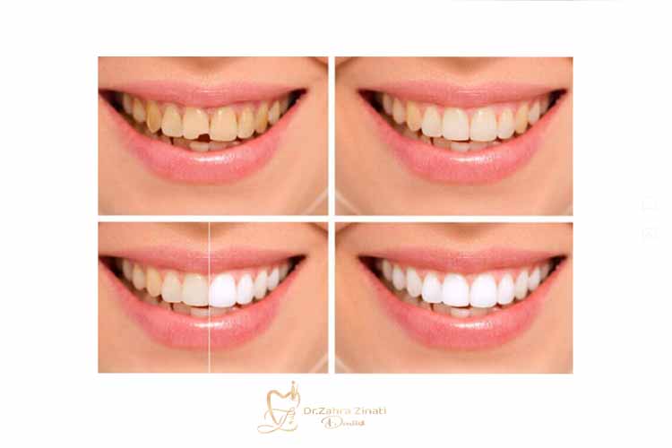 نمونه باندینگ کامپوزیت
