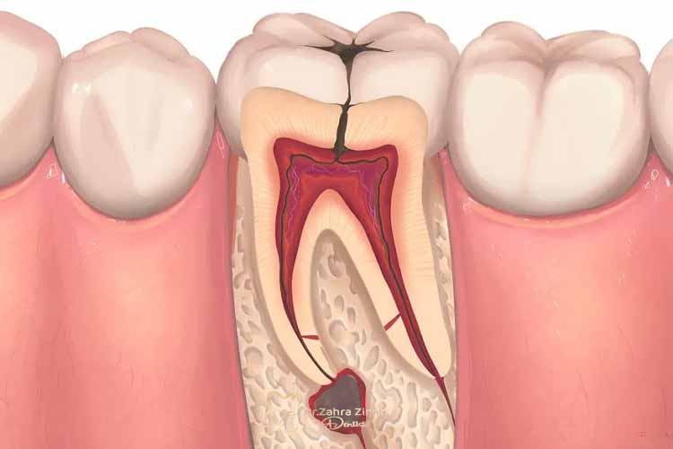 درمان ریشه دندان 