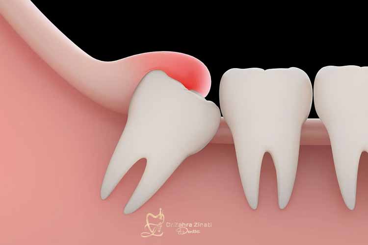 علائم نیاز به کشیدن دندان عقل