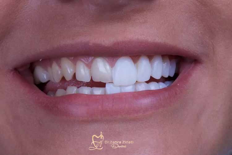 ماندگاری ونیر کامپوزیت