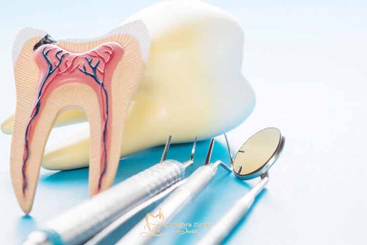 هزینه درمان ریشه دندان
