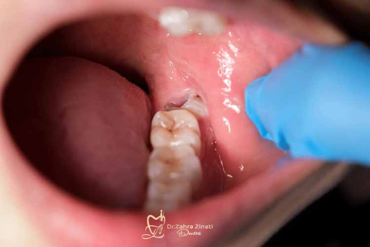 کشیدن دندان عقل 