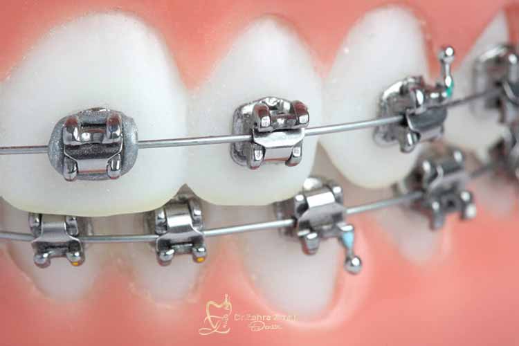 کاربرد ارتودنسی دیمون