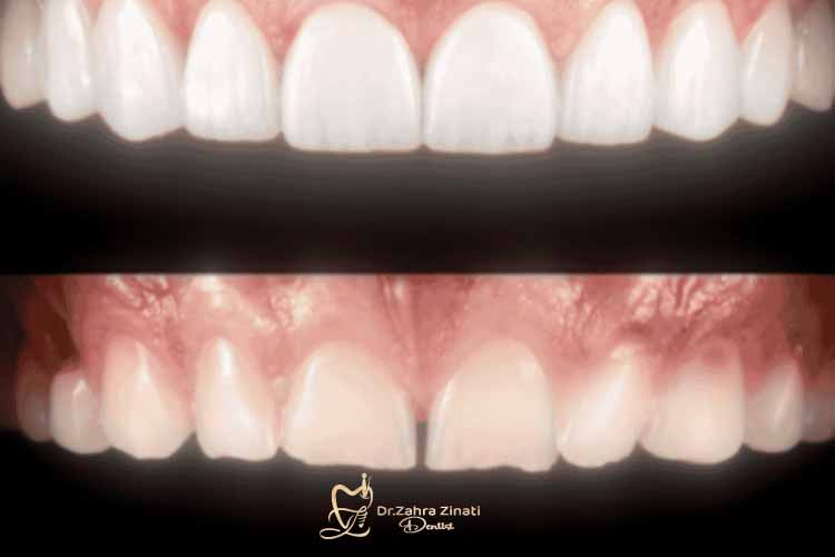 هزینه باندینگ کامپوزیت