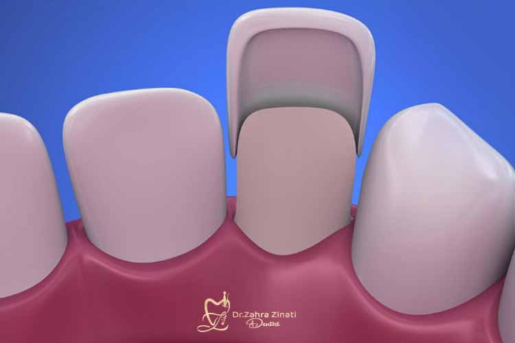 راه های افزایش دوام ونیر کامپوزیت