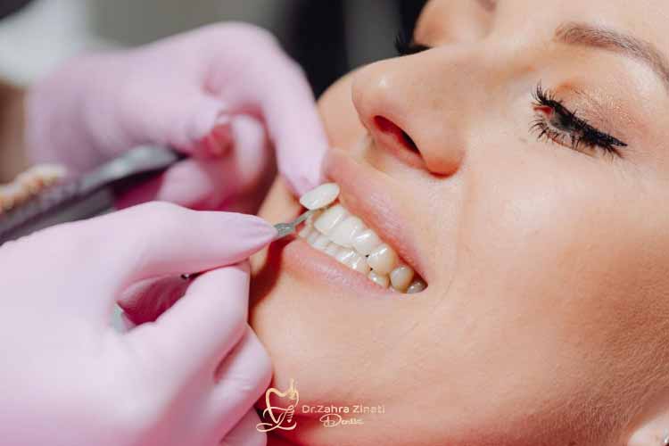 علت دوام ونیر کامپوزیت