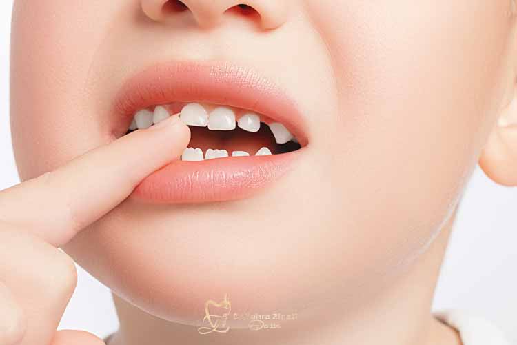 سن درآمدن دندان شیری