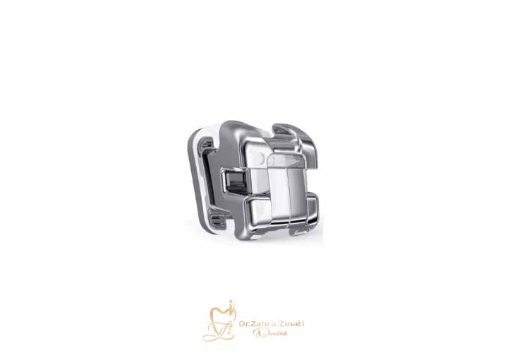 مدت زمان ارتودنسی دیمون