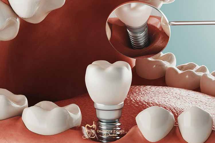 پروتز دندان