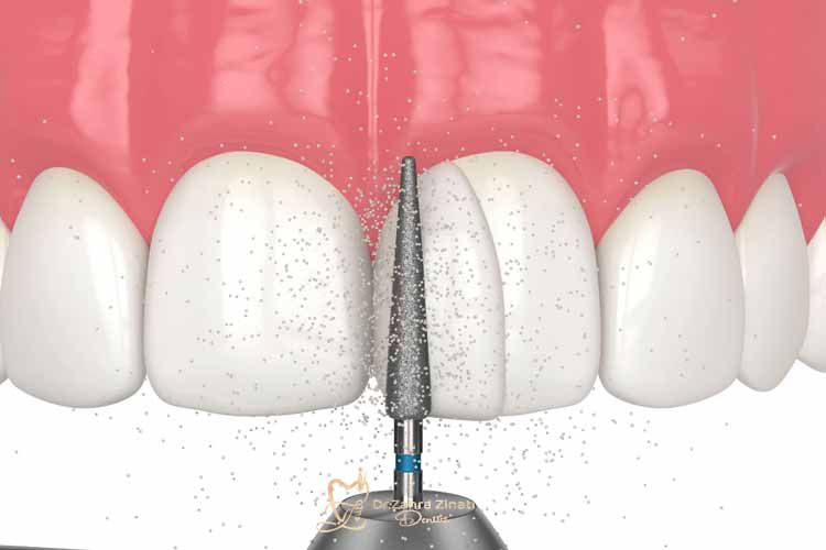 باندینگ کامپوزیت؛ رویکرد علمی و مدرن در بازسازی لبخند
