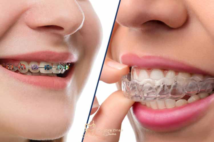 مقایسه بریس شفاف و ارتودنسی ثابت در درمان‌های ارتودنسی امروز