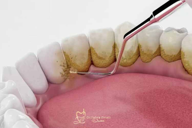 مراحل جرم گیری دندان