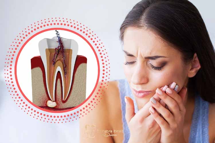 مدت زمان درد عصب کشی