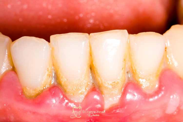 جرم‌گیری زیر لثه