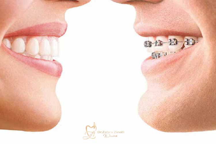 بریس شفاف و ارتودنسی ثابت؛ مقایسه مدت درمان از ۳ ماه اول تا نتیجه نهایی