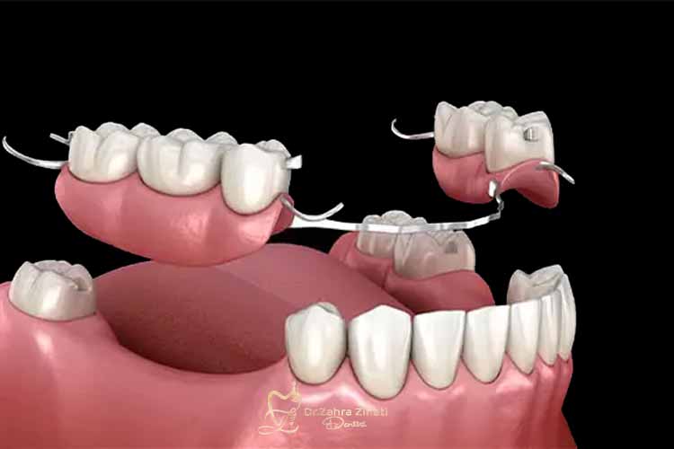 نگهداری پروتز دندان 