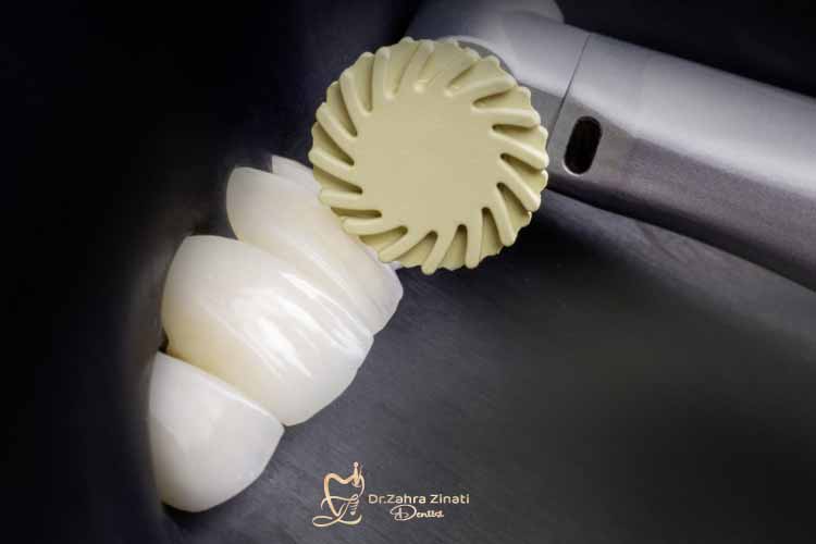 راهنمای پولیش دندان 