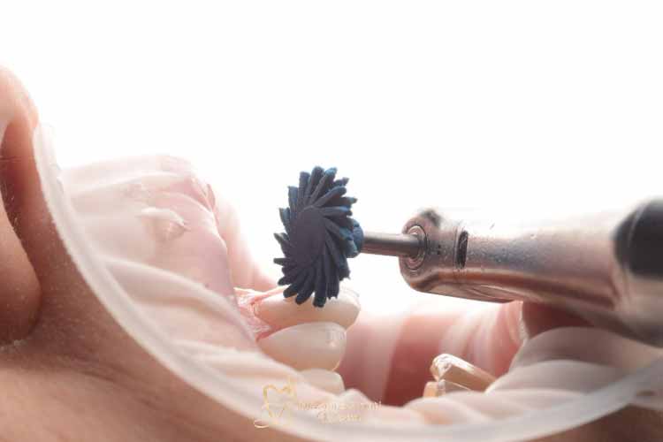 هزینه پولیش دندان