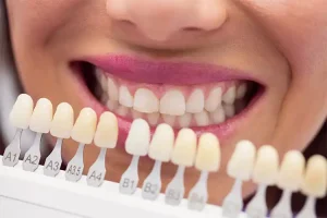 نمای نزدیک لبخند پیش و پس از کامپوزیت ونیر
