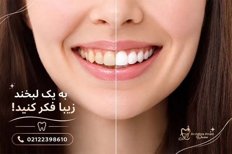 بلیچینگ دندان چقدر دوام دارد