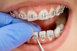 چرا سلامت دهان قبل از ارتودنسی مهم است