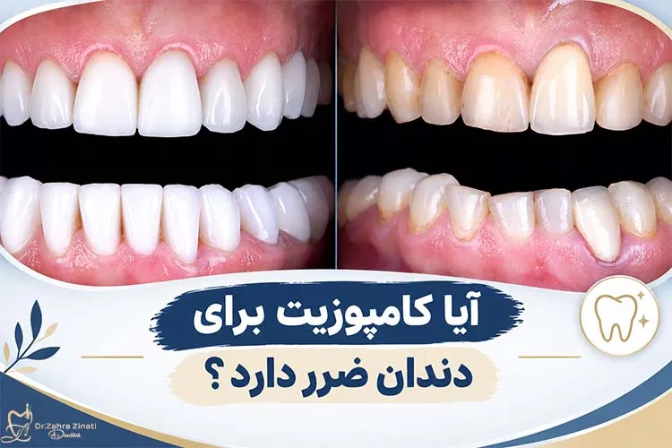 آیا کامپوزیت باعث پوسیدگی دندان می‌شود