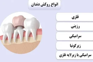 انواع روکش دندان برای دندانهای عقب